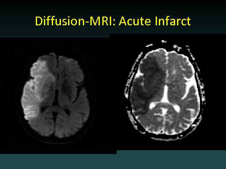Diffusion-MRI: Acute Infarct 