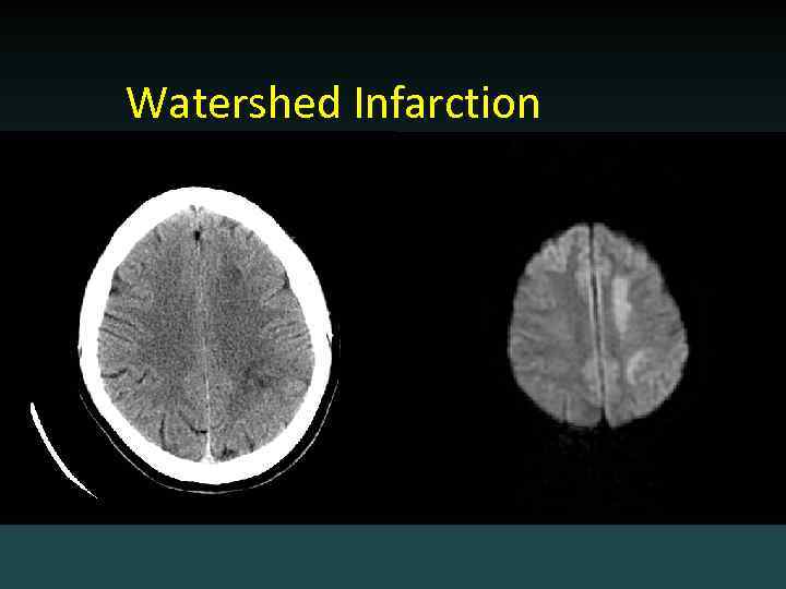 Watershed Infarction 
