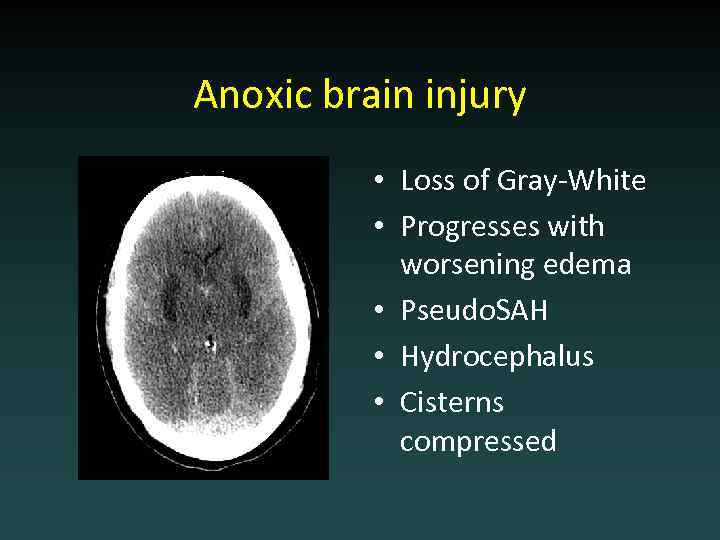 Anoxic brain injury • Loss of Gray-White • Progresses with worsening edema • Pseudo.