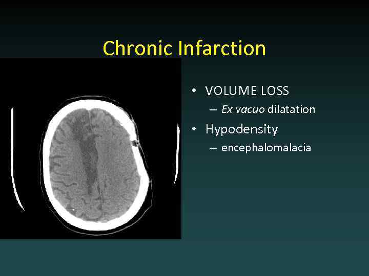 Chronic Infarction • VOLUME LOSS – Ex vacuo dilatation • Hypodensity – encephalomalacia 
