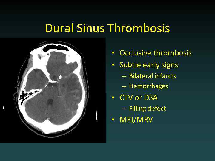 Dural Sinus Thrombosis • Occlusive thrombosis • Subtle early signs – Bilateral infarcts –