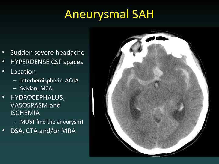 Aneurysmal SAH • Sudden severe headache • HYPERDENSE CSF spaces • Location – Interhemispheric: