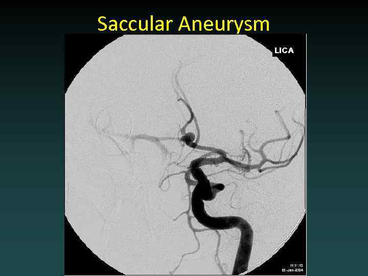 Saccular Aneurysm 