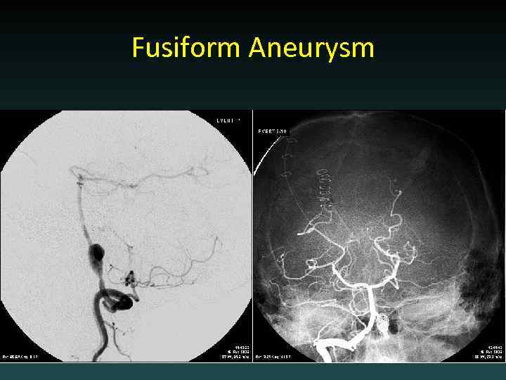 Fusiform Aneurysm 