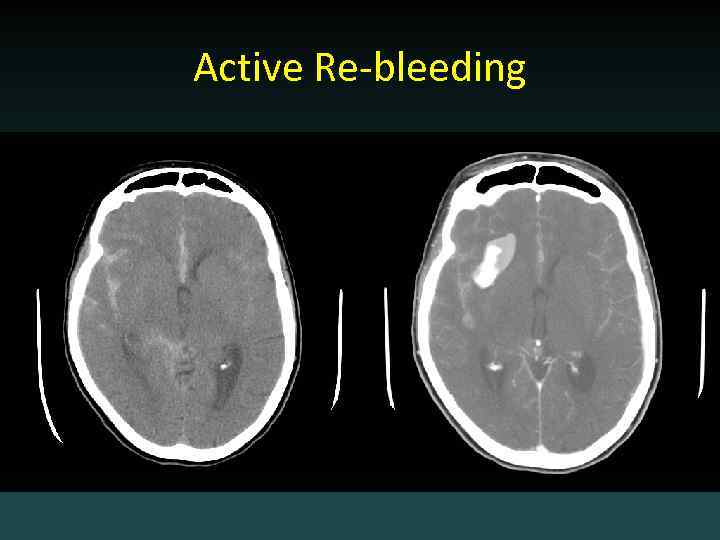 Active Re-bleeding 