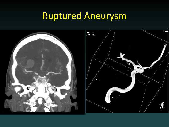 Ruptured Aneurysm 