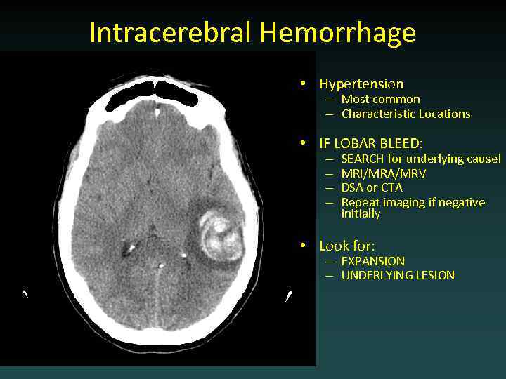 Intracerebral Hemorrhage • Hypertension – Most common – Characteristic Locations • IF LOBAR BLEED: