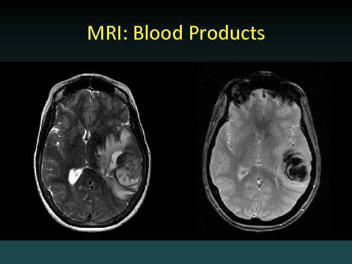 MRI: Blood Products 