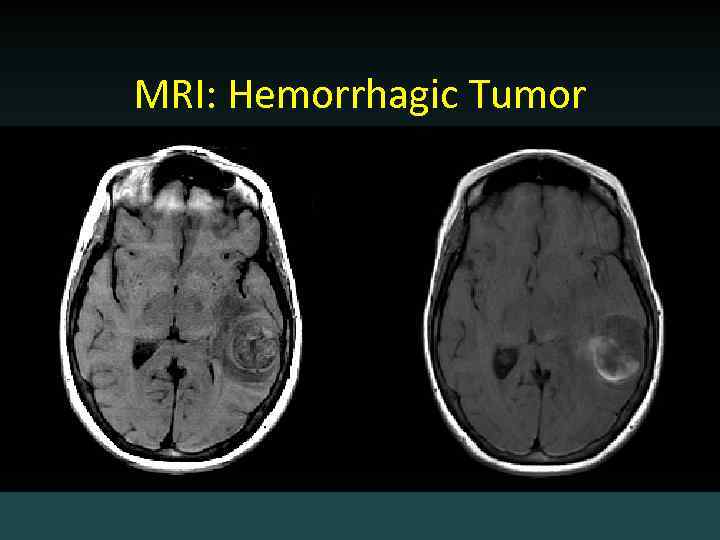 MRI: Hemorrhagic Tumor 