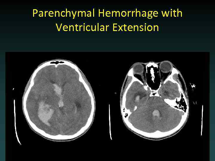 Parenchymal Hemorrhage with Ventricular Extension 