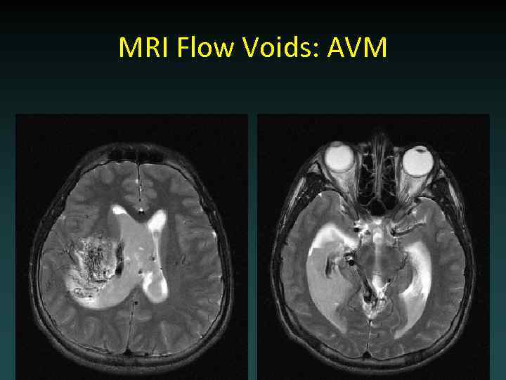 MRI Flow Voids: AVM 
