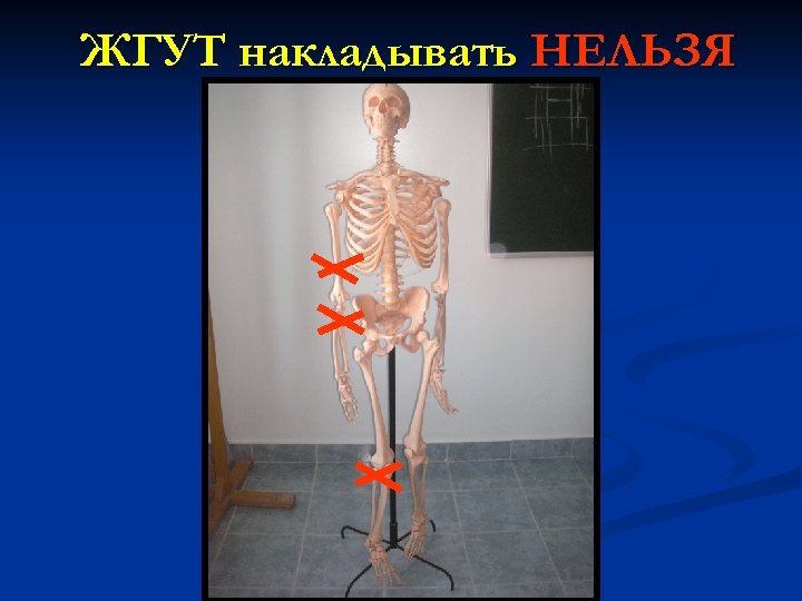 ЖГУТ накладывать НЕЛЬЗЯ 