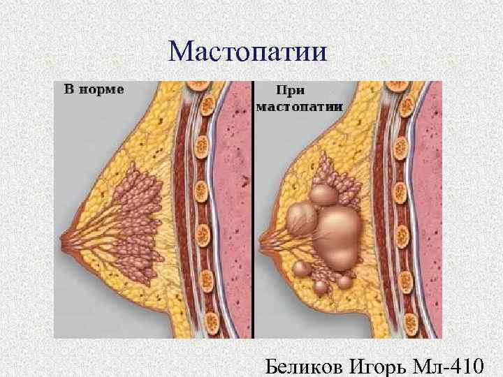 Мастопатии Беликов Игорь Мл 410 