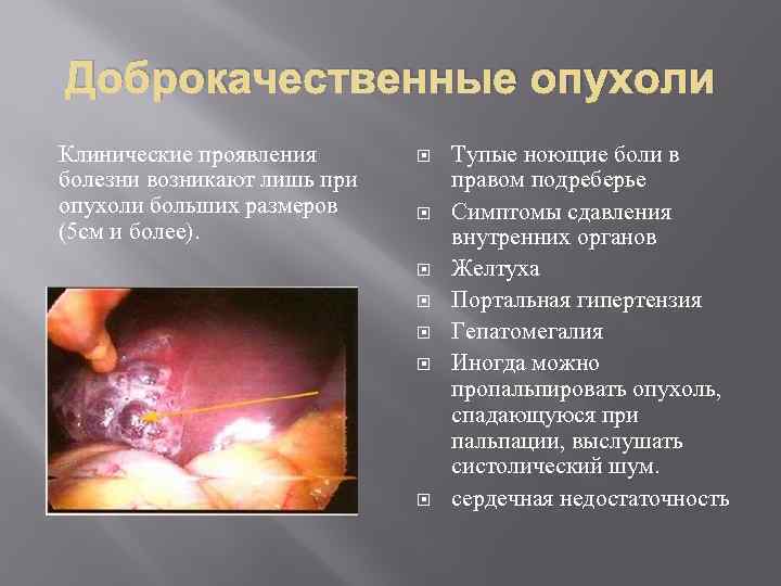 Доброкачественные опухоли Клинические проявления болезни возникают лишь при опухоли больших размеров (5 см и