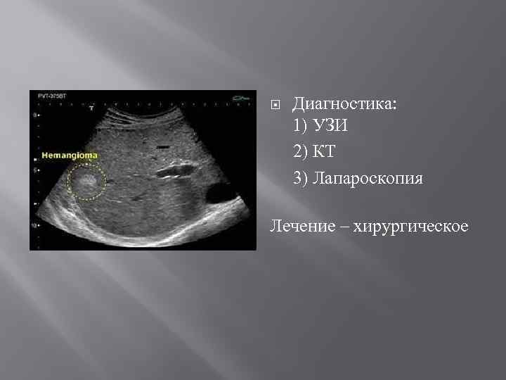  Диагностика: 1) УЗИ 2) КТ 3) Лапароскопия Лечение – хирургическое 