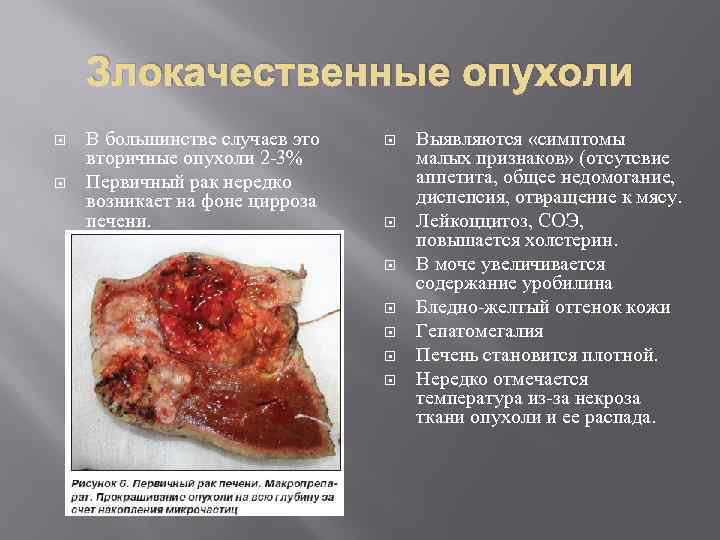 Злокачественные опухоли В большинстве случаев это вторичные опухоли 2 -3% Первичный рак нередко возникает