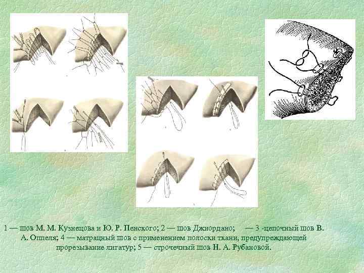 1 — шов М. М. Кузнецова и Ю. Р. Пенского; 2 — шов Джиордано;