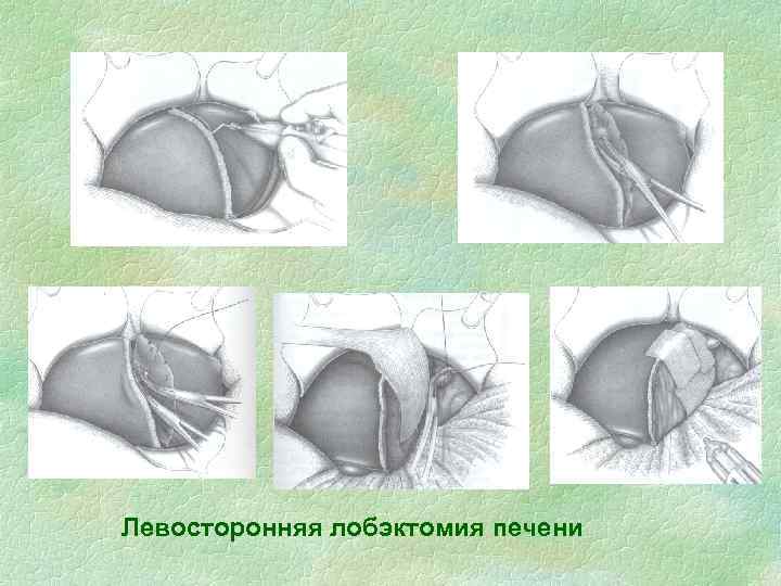 Левосторонняя лобэктомия печени 