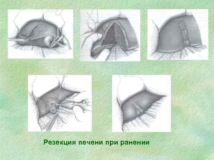 Резекция печени при ранении 