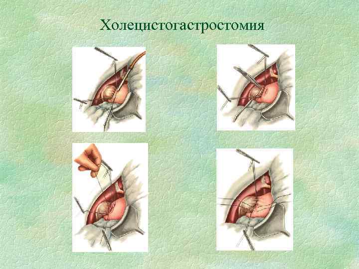 Холецистогастростомия 