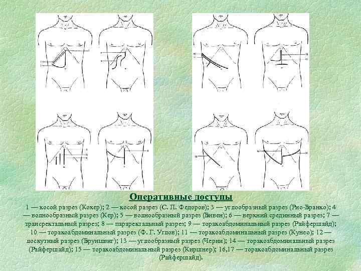 Оперативные доступы 1 — косой разрез (Кохер); 2 — косой разрез (С. П. Федоров);