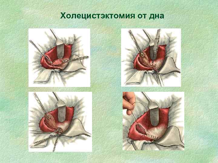 Холецистэктомия от дна 