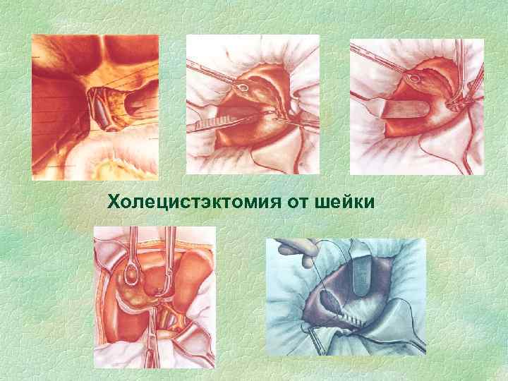 Холецистэктомия от шейки 