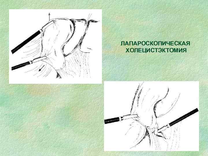 ЛАПАРОСКОПИЧЕСКАЯ ХОЛЕЦИСТЭКТОМИЯ 