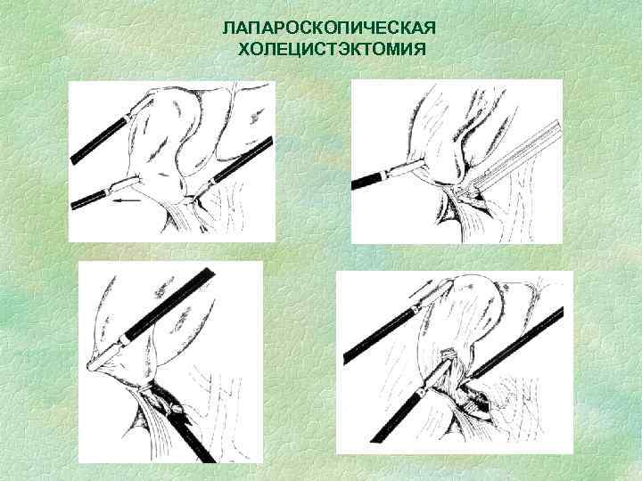 ЛАПАРОСКОПИЧЕСКАЯ ХОЛЕЦИСТЭКТОМИЯ 