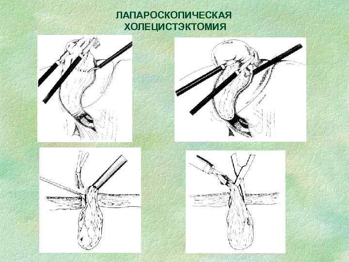 ЛАПАРОСКОПИЧЕСКАЯ ХОЛЕЦИСТЭКТОМИЯ 