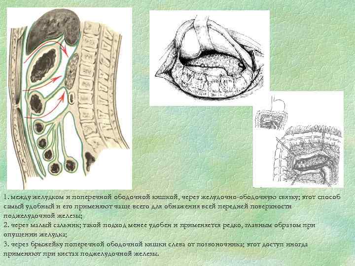 1. между желудком и поперечной ободочной кишкой, через желудочно-ободочную связку; этот способ самый удобный
