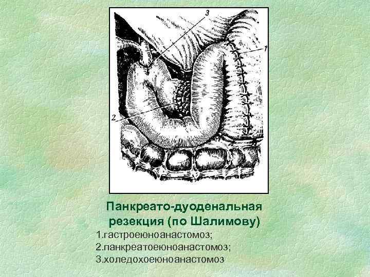 Панкреато-дуоденальная резекция (по Шалимову) 1. гастроеюноанастомоз; 2. панкреатоеюноанастомоз; 3. холедохоеюноанастомоз 