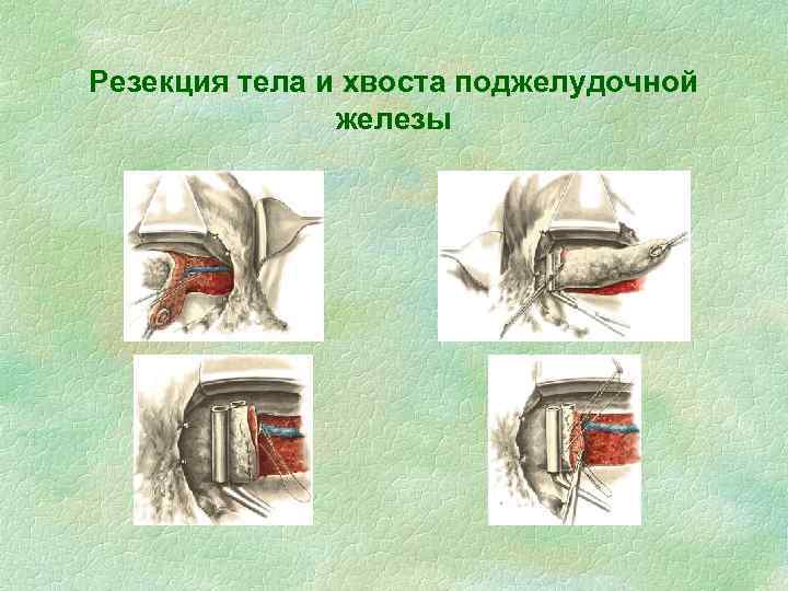 Резекция тела и хвоста поджелудочной железы 