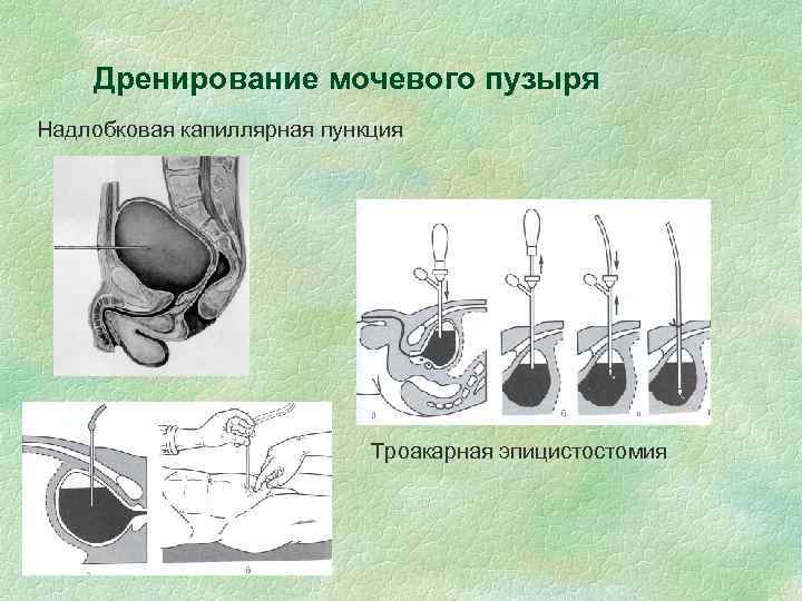 Дренирование мочевого пузыря Надлобковая капиллярная пункция Троакарная эпицистостомия 