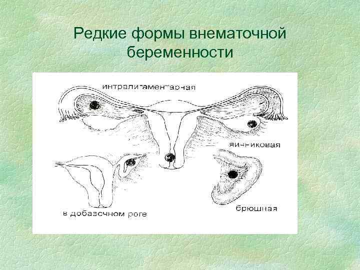 Тактика врача при внематочной беременности