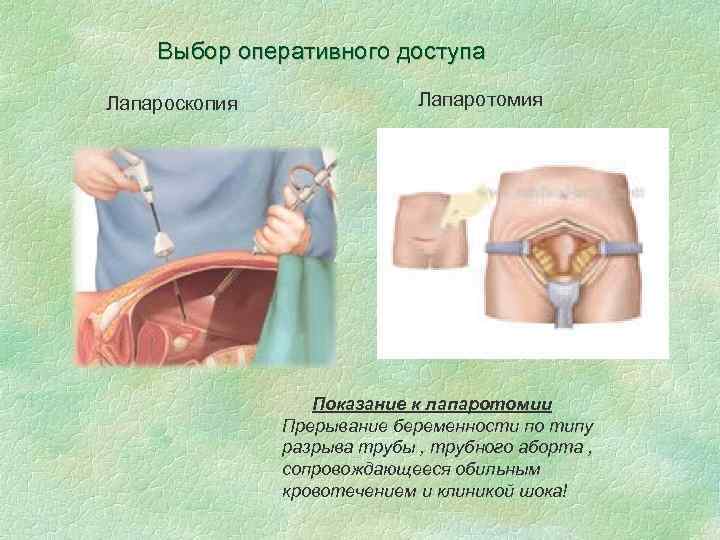 Выбор оперативного доступа Лапароскопия Лапаротомия Показание к лапаротомии Прерывание беременности по типу разрыва трубы