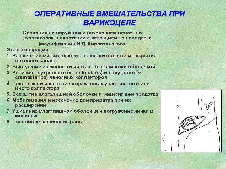ОПЕРАТИВНЫЕ ВМЕШАТЕЛЬСТВА ПРИ ВАРИКОЦЕЛЕ Операция на наружном и внутреннем венозных коллекторах в сочетании с