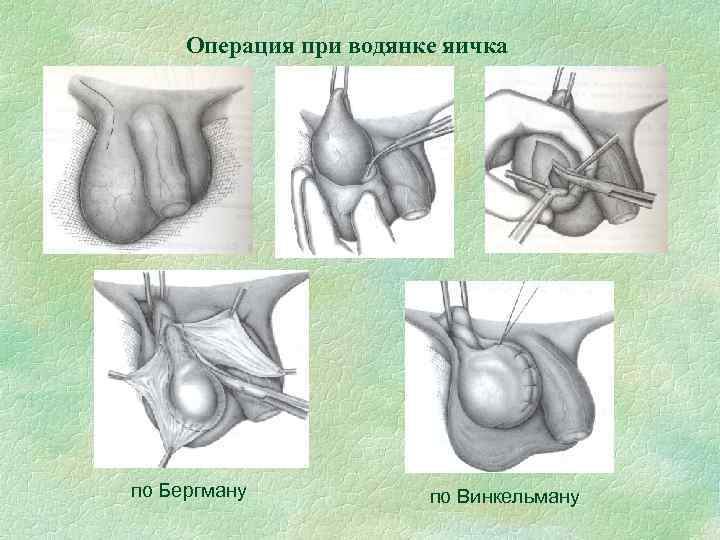Операция при водянке яичка по Бергману по Винкельману 