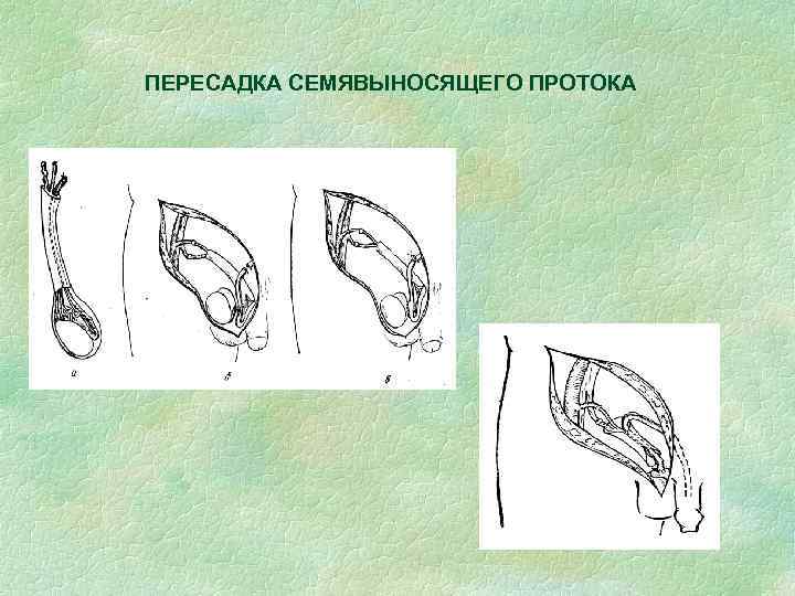 ПЕРЕСАДКА СЕМЯВЫНОСЯЩЕГО ПРОТОКА 