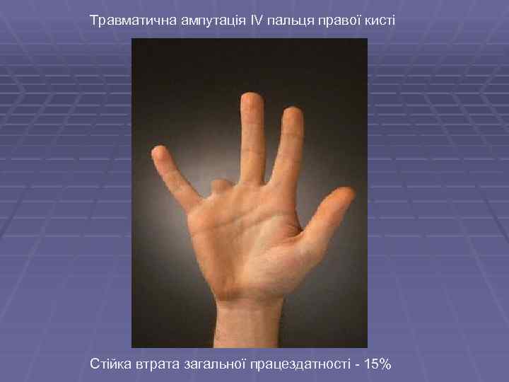 Травматична ампутація IV пальця правої кисті Стійка втрата загальної працездатності - 15% 