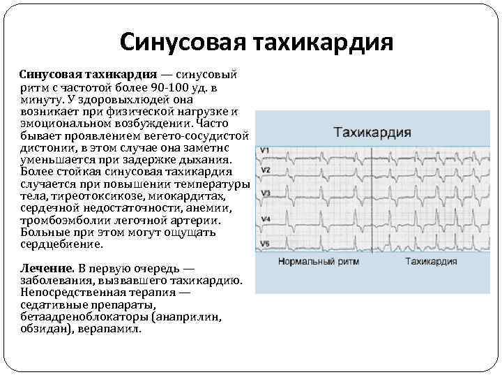 Синусовая тахикардия это. Ритм синусовая тахикардия 100 уд/мин. Купирование синусовой тахикардии. Синусовая тахикардия при нагрузке. Синусовая тахикардия после физической нагрузки.