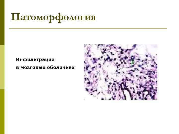 Патоморфология Инфильтрация в мозговых оболочках 