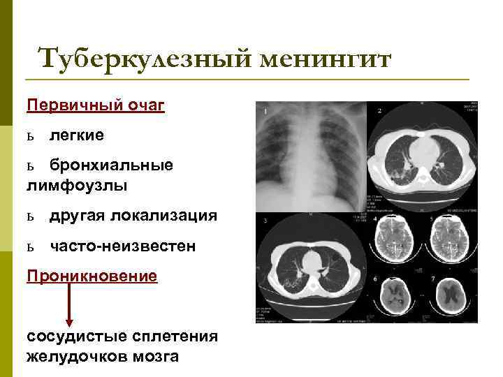 В основную схему лечения туберкулезного менингита входит