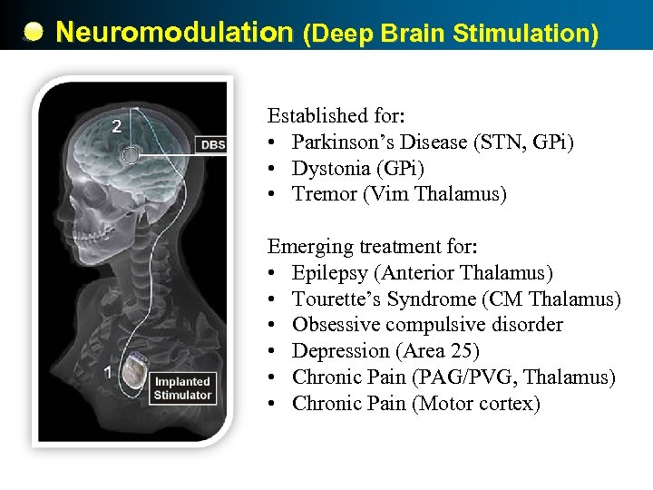 Neuromodulation (Deep Brain Stimulation) Established for: • Parkinson’s Disease (STN, GPi) • Dystonia (GPi)