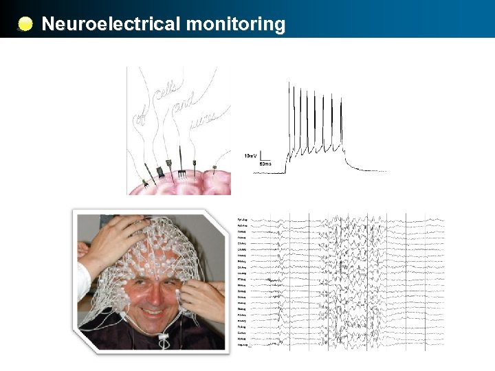 Neuroelectrical monitoring 