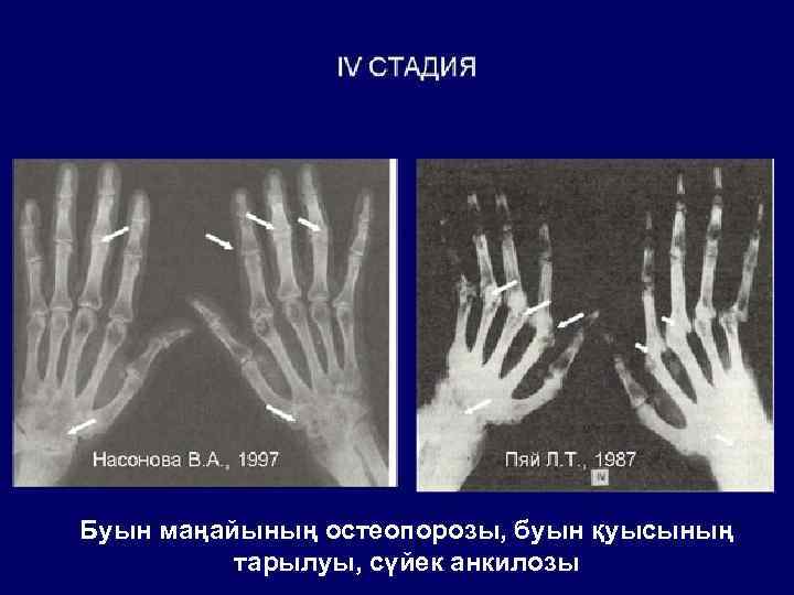 Буын маңайының остеопорозы, буын қуысының тарылуы, сүйек анкилозы 