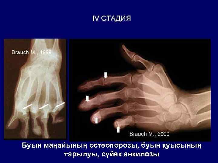 Буын маңайының остеопорозы, буын қуысының тарылуы, сүйек анкилозы 