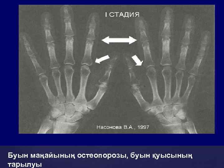 Буын маңайының остеопорозы, буын қуысының тарылуы 