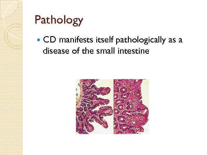 Pathology CD manifests itself pathologically as a disease of the small intestine 