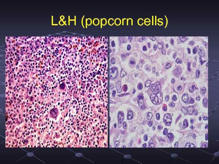 Диффузная крупноклеточная в клеточная. Лимфома Ходжкина нодулярный склероз гистология. Клетки Ходжкина гистология. Клетки попкорн при лимфоме Ходжкина.